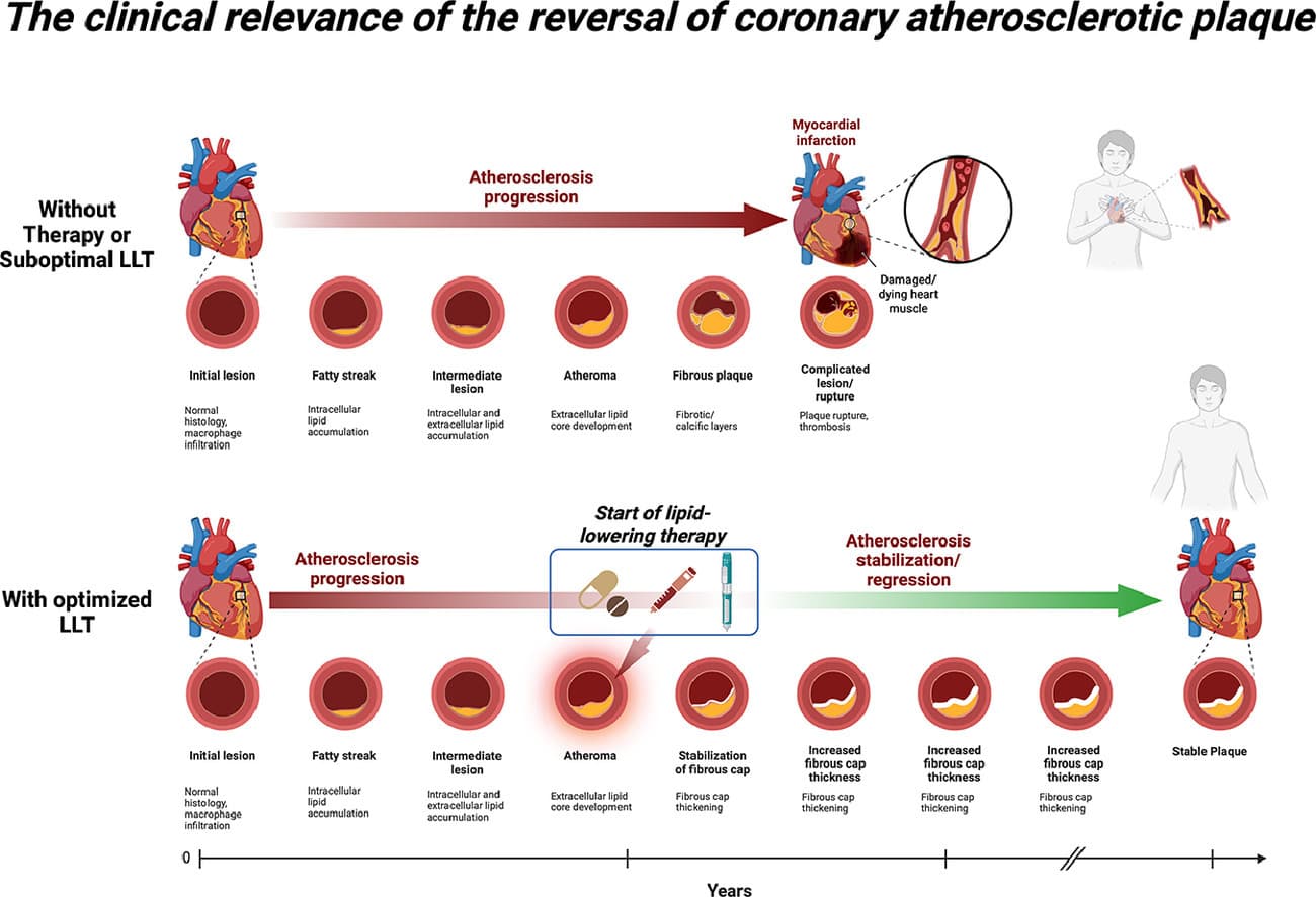 Figure from: The Clinical Relevance of the Reversal of Coronary Atherosclerotic Plaque